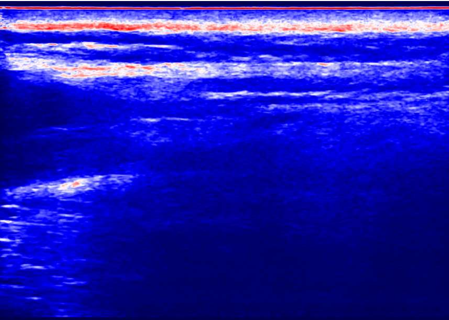 Connective tissue analysis showing blue and red regions indicating tissue stiffness
