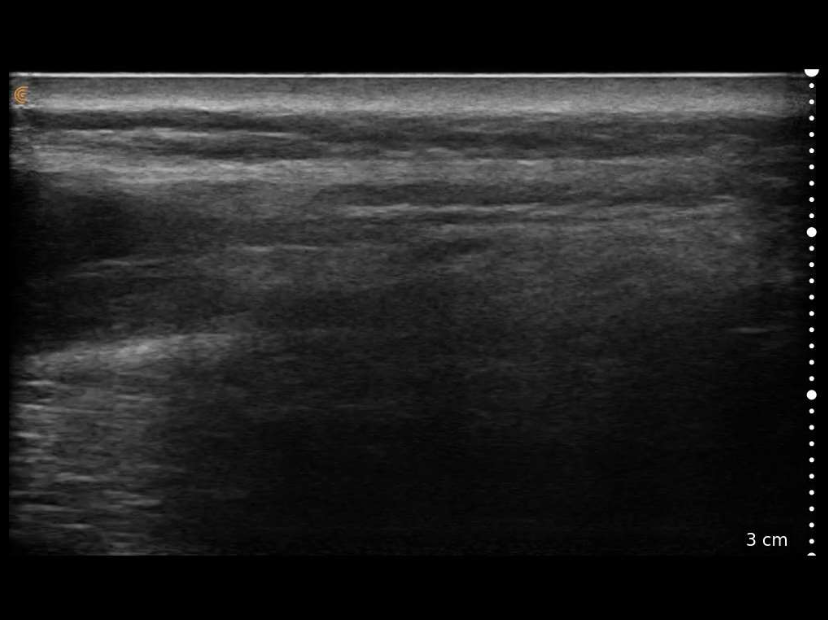 Grayscale ultrasound scan showing tissue layers